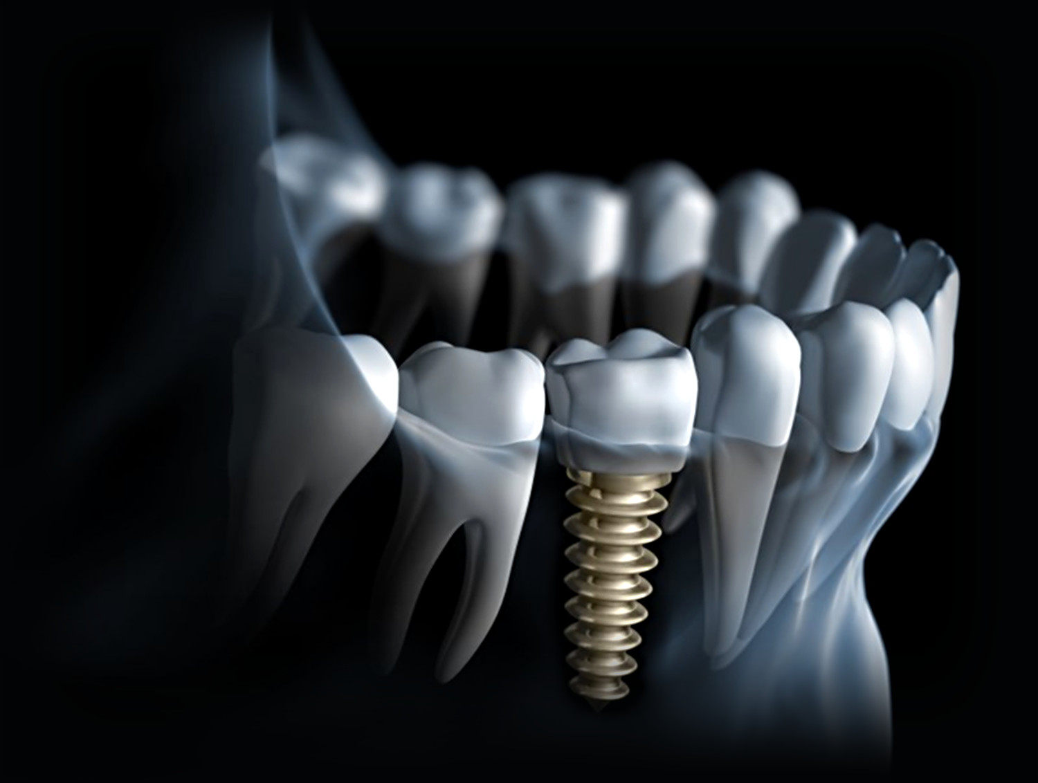 Dental implant placed in the lower jaw