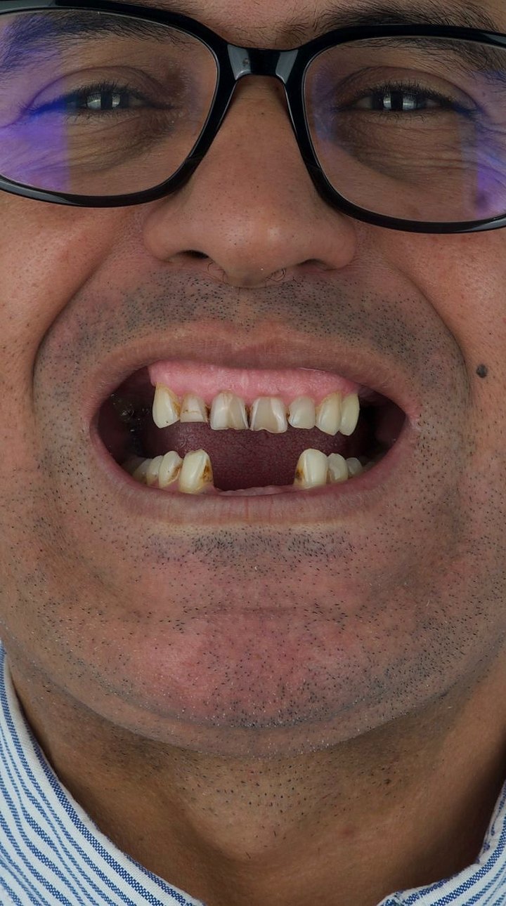 Patient A before treatment